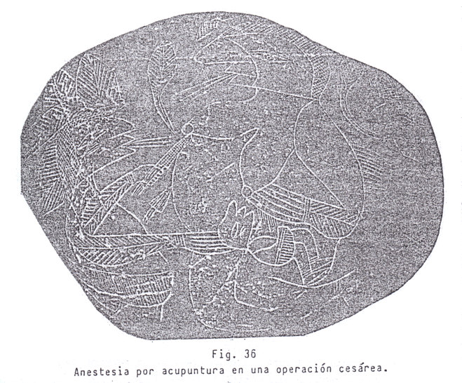 Fig.
                                36: Anestesia con acupuntura en una
                                operacin de cesrea
