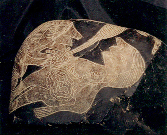 Heart surgery
                            with a man 04