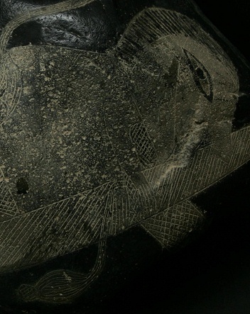 Operaci�n de ri��n, el paciente est�
                            con una infusi�n