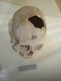 Drilled skull 01
