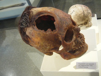 Cráneo trepanado 03 Cráneo trepanado 03