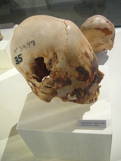 Cráneo trepanado 04 Cráneo trepanado 04