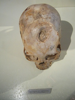 Drilled skull 05, healed over,
                                    second photo