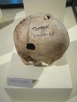 Cráneo trepanado 06 Cráneo trepanado 06