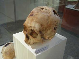 Cráneo trepanado 02 Cráneo trepanado 02