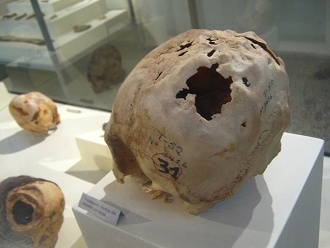 Cráneo trepanado 02,
primer plano Cráneo trepanado 02, primer
plano