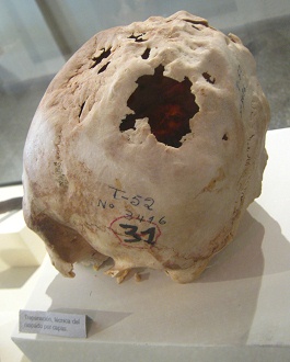 Cráneo trepanado
02, primer plano 02 Cráneo trepanado 02, primer
plano 02