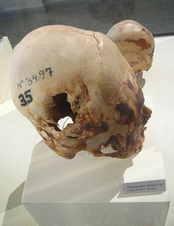 Cráneo trepanado 04,
segunda foto Cráneo trepanado 04, segunda
foto