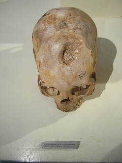 Cráneo trepanado 05, cerrado Cráneo trepanado 05, cerrado