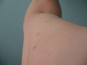 Fl�he, reihenartiges Frassbild der Flohbisse
                      am rechten Oberarm